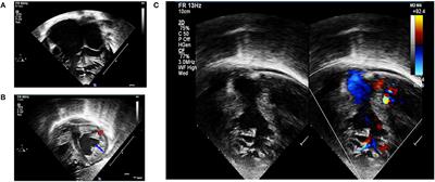 A Novel Homozygous PKP2 Variant in Severe Neonatal Non-compaction and Concomitant Ventricular Septal Defect: A Case Report